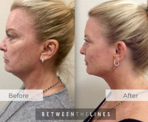 Kybella | facial fillers | aesthetics | orange county