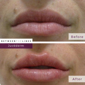 aesthetic botox juvederm lip filler orange county