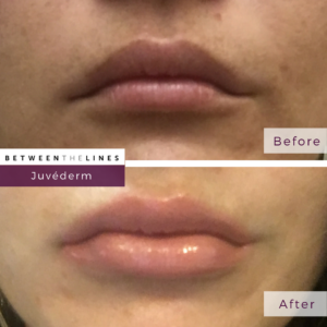 Between The Lines Juvéderm Ultra Plus lip filler medical spa botox huntington beach orange county