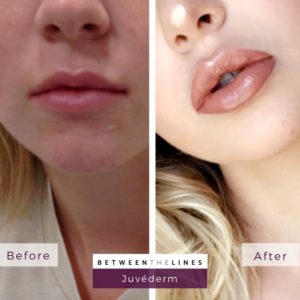 aesthetic botox juvederm lip filler orange county