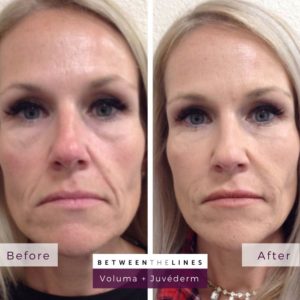 aesthetic botox juvederm lip filler orange county