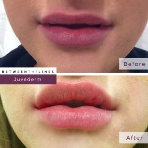 aesthetic botox juvederm lip filler orange county