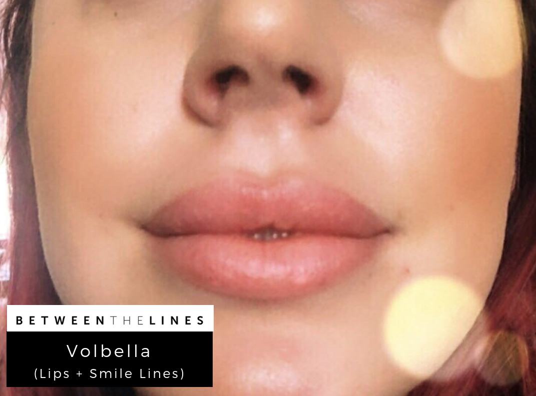 Between The Lines Aesthetic Huntington Beach juvederm botox lip filler