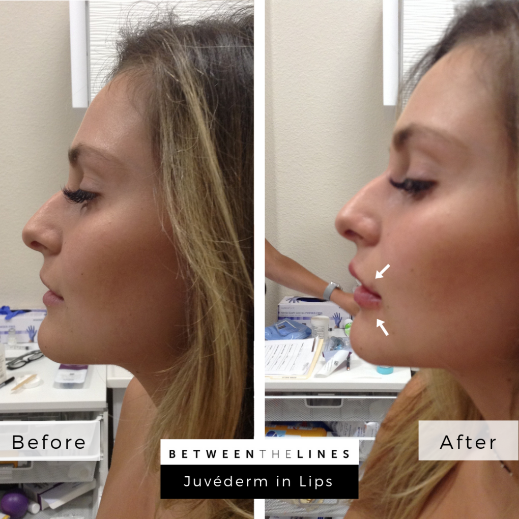 Juv derm ultra plus between the lines