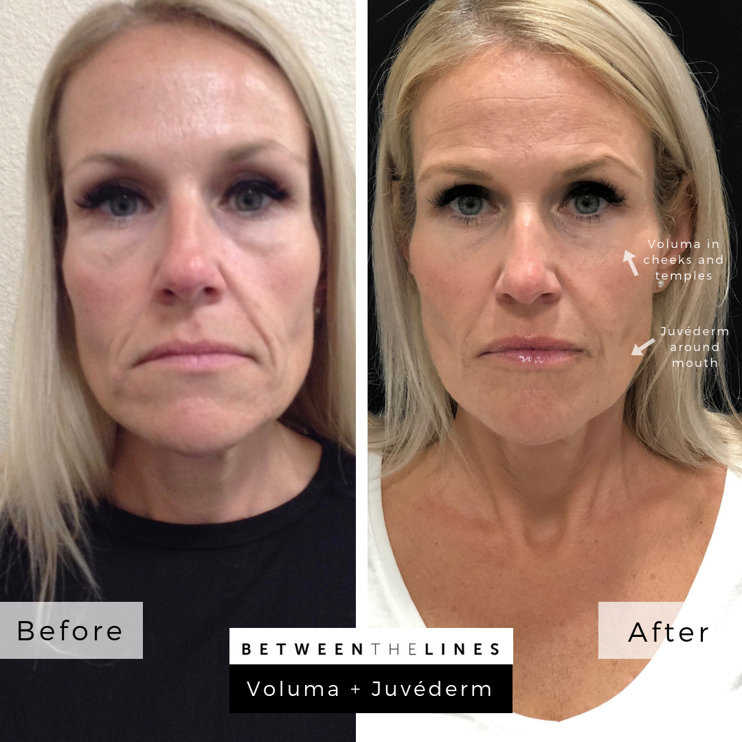 Between The Lines Aesthetic Huntington Beach juvederm botox lip filler