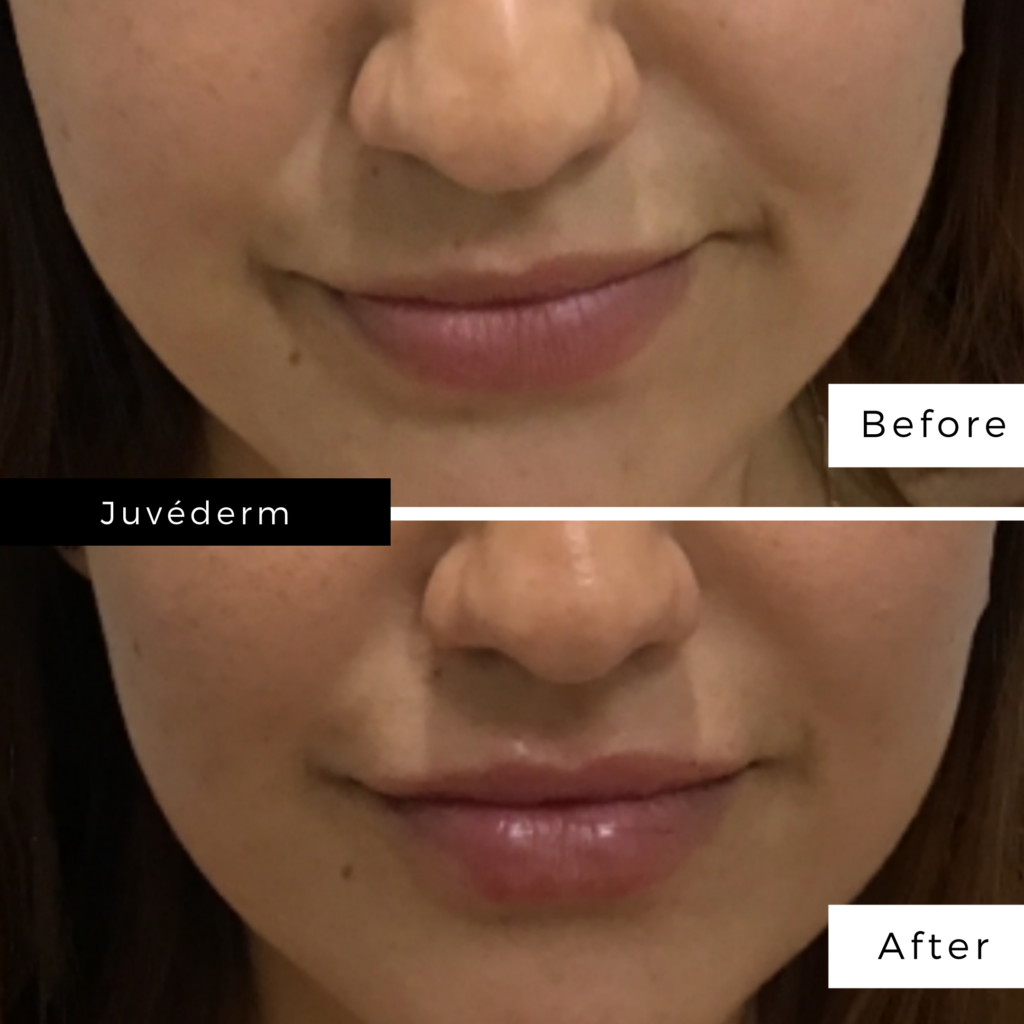 JUVADERM Collection of Fillers – Modern Dermatology